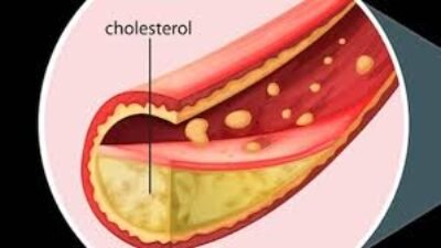 Penyebab Kolesterol Tinggi yang Perlu Diwaspadai, Jangan Hanya Salahkan Daging Kurban
